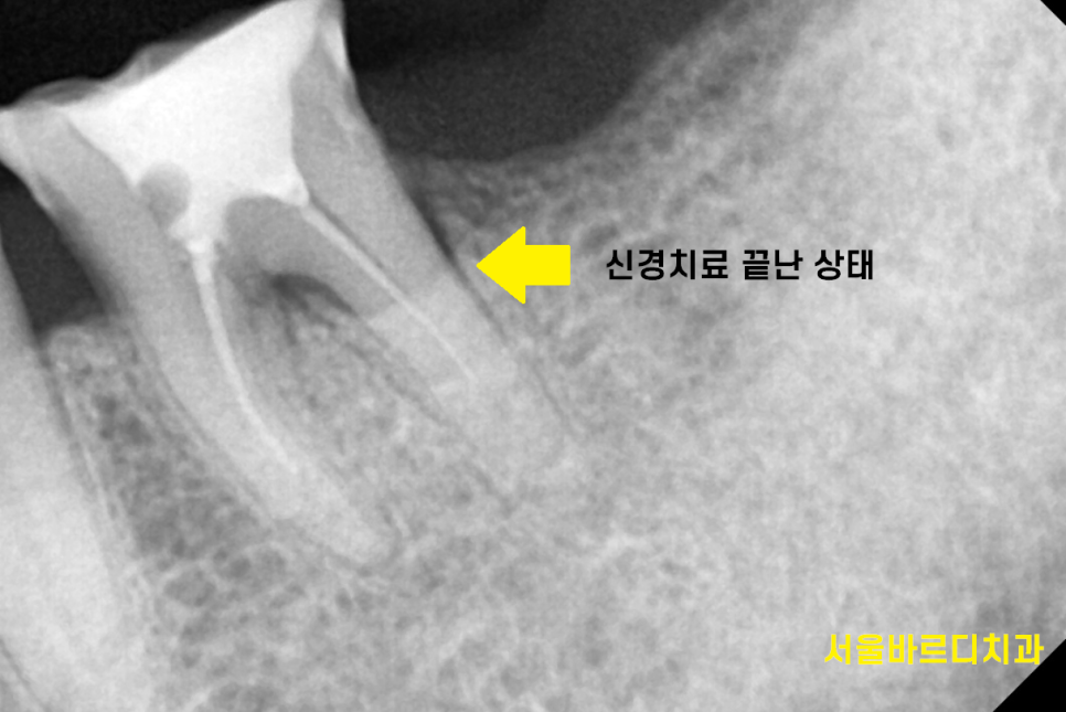 신경치료 후 통증 치아 뿌리 금으로 발치 후 강일역 임플란트 관련 이미지 4