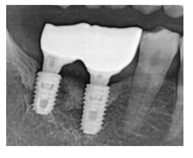 고덕동치과 임플란트 악취 냄새가 나는 이유는? 관련 이미지 2