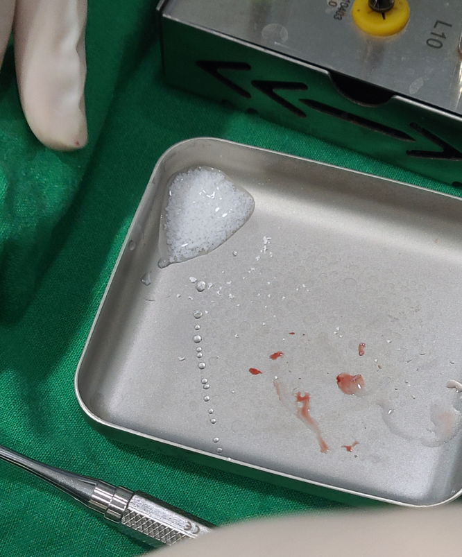 비절개 임플란트 추구하는 3가지 이유 관련 이미지 7