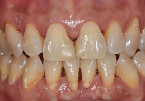 고덕동 치과 누런 이, 앞니 사이 틈, 잘못된 관리 때문일까? 관련 이미지 14