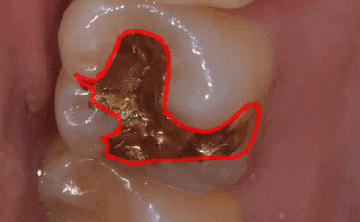 치아 땜질 다 떼울 수는 없지만..강동구 치과에서는 이렇게 합니다. 관련 이미지 1