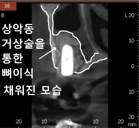 잇몸 고름 눌러보니 푹... 임플란트 주위염 방치했다가 재수술한 사례 관련 이미지 13