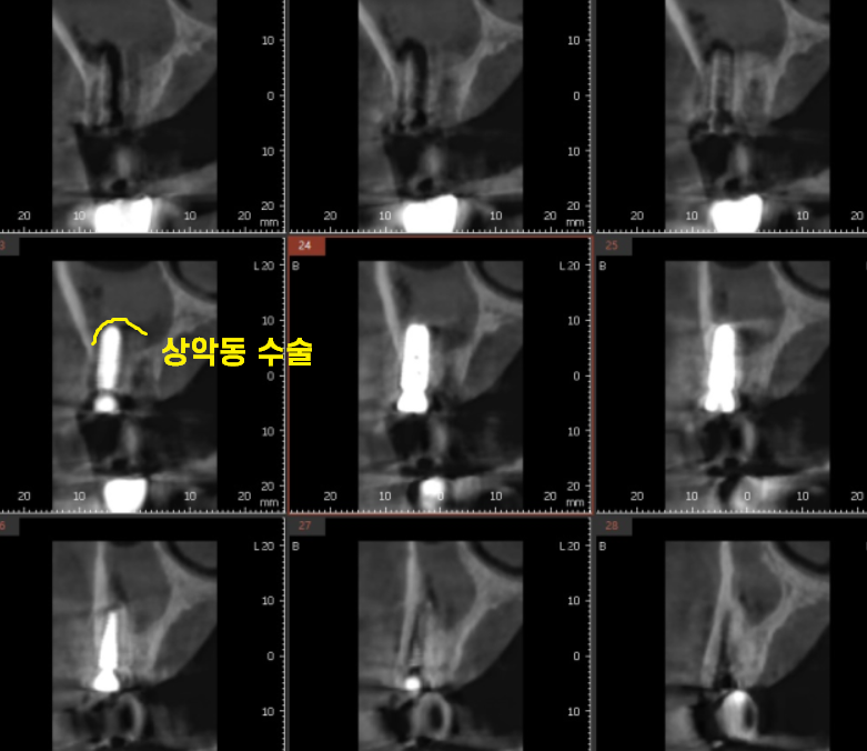 감일동 치과 어금니 시림 충치가 아닐 수도 있다? 임플란트 하게된 사연 관련 이미지 6