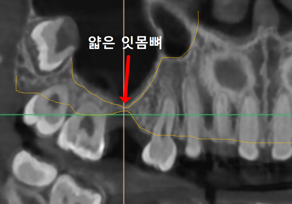 얇은 잇몸뼈 때문에 임플란트 하기 힘들다면? 저희는 관련 이미지 4