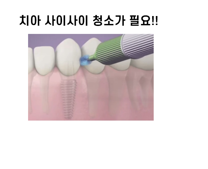임플란트 잇몸 염증 반복되면 재수술도 필요합니다. 관련 이미지 5