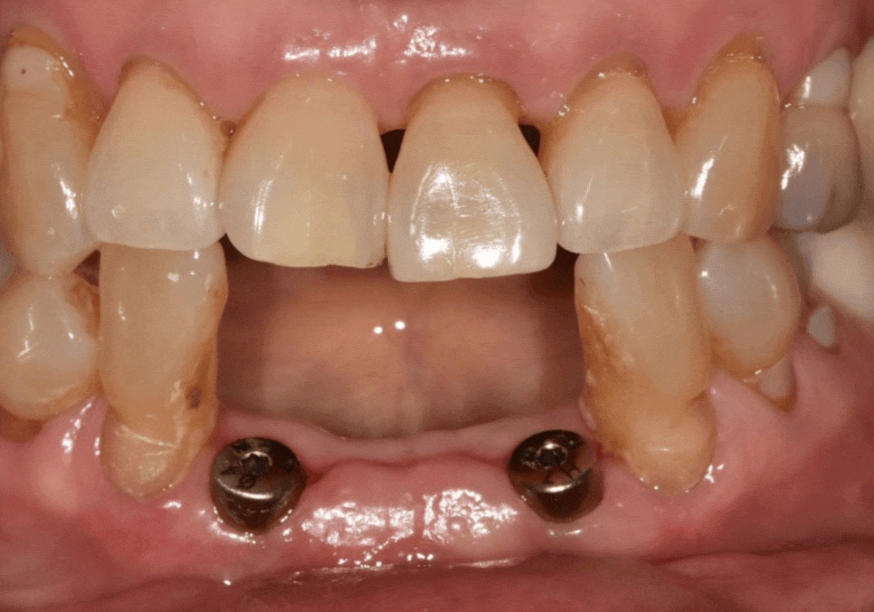 흔들리는 치아 묶어두는 잠간고정술, 오히려 잇몸뼈를 녹일 수도 있다고요? 관련 이미지 12