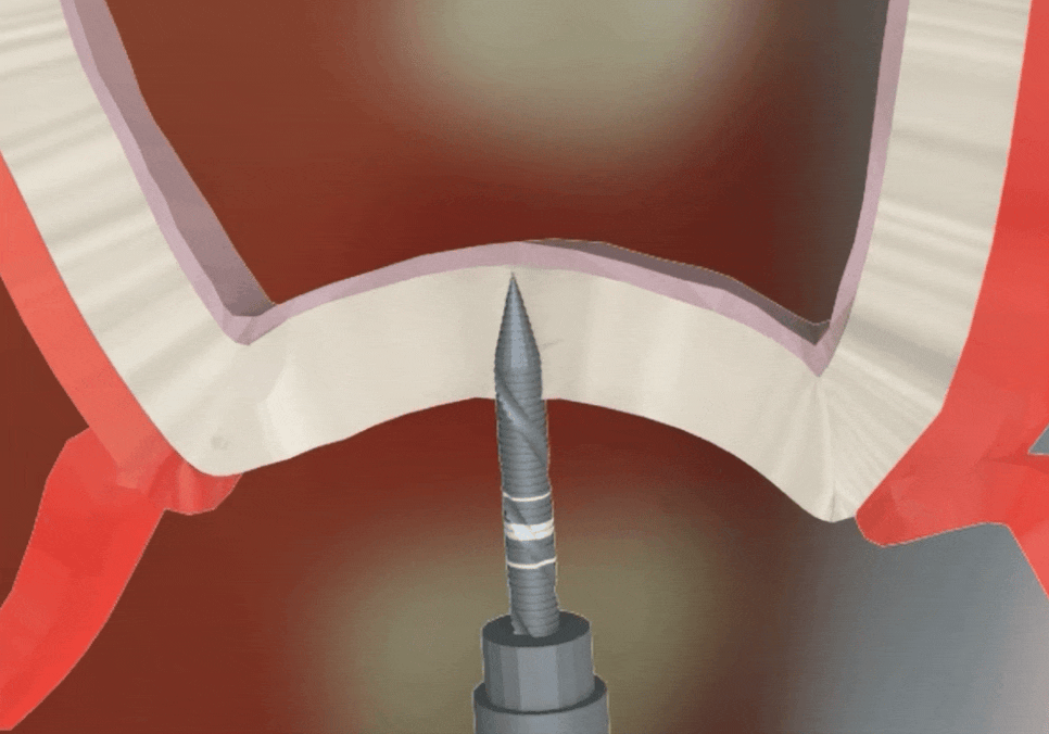 얇은 잇몸뼈 때문에 임플란트 하기 힘들다면? 저희는 관련 이미지 7