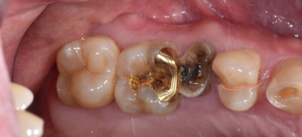 어금니 치아 파절 부러짐 발치까지 이어질 수 있습니다. 관련 이미지 7