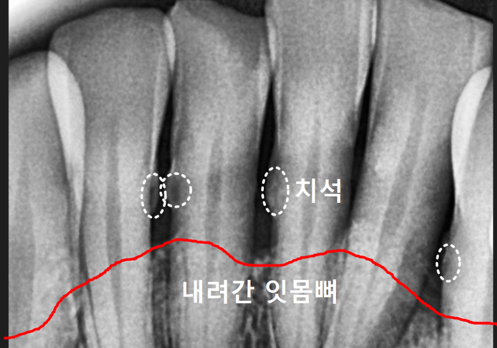 고덕동 스케일링 미루다 앞니 어금니 다 뽑고 임플란트 했습니다. 관련 이미지 13