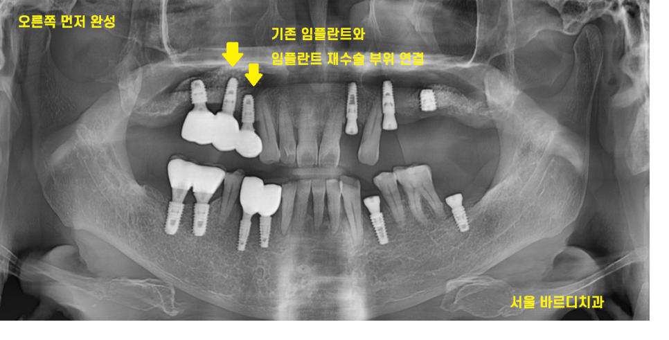 상일동역 근처 치과 타원 임플란트 제거 후 재식립 케이스 관련 이미지 8