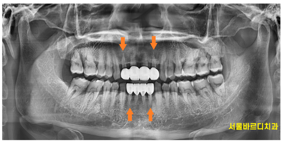 앞니 사이 간격 넓어짐 치아가 벌어져서 보기 싫을 때 크라운 치료 관련 이미지 9