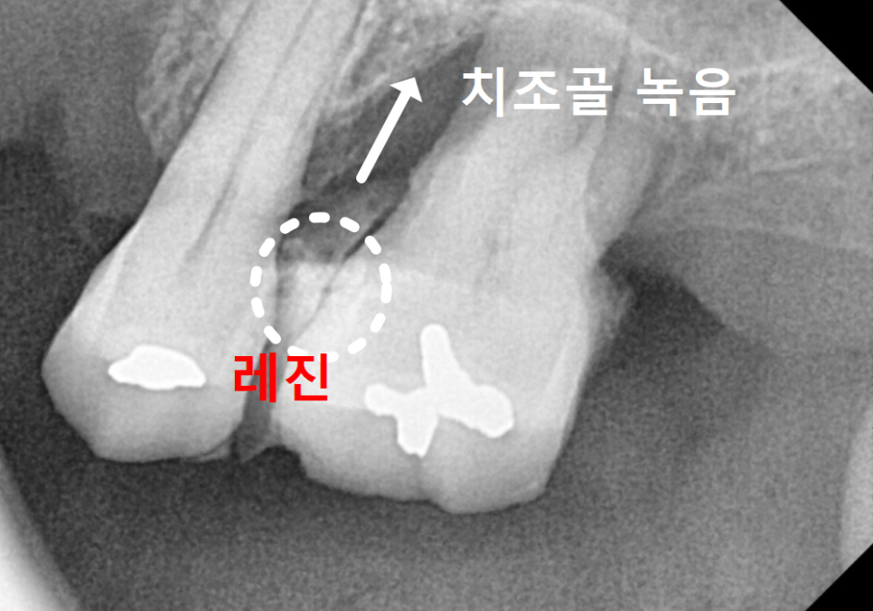 Gangil-dong Molar Implant, "It’s Loose—Can’t You Just Bond It with Resin?" image 4
