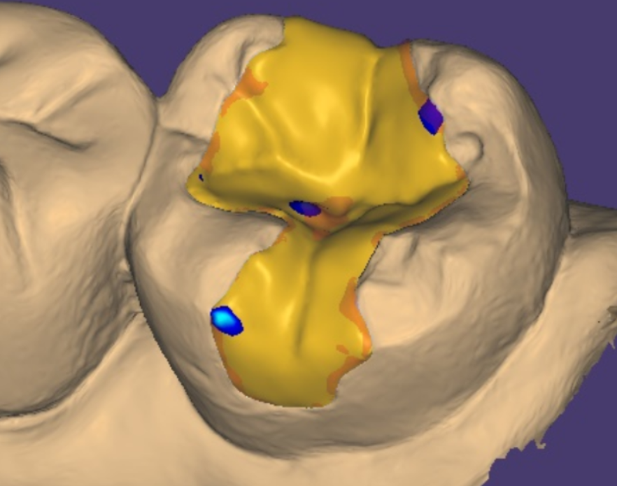 고덕동 치과 디지털 임플란트는 뭔가요? 뭐가 달라요? 관련 이미지 6