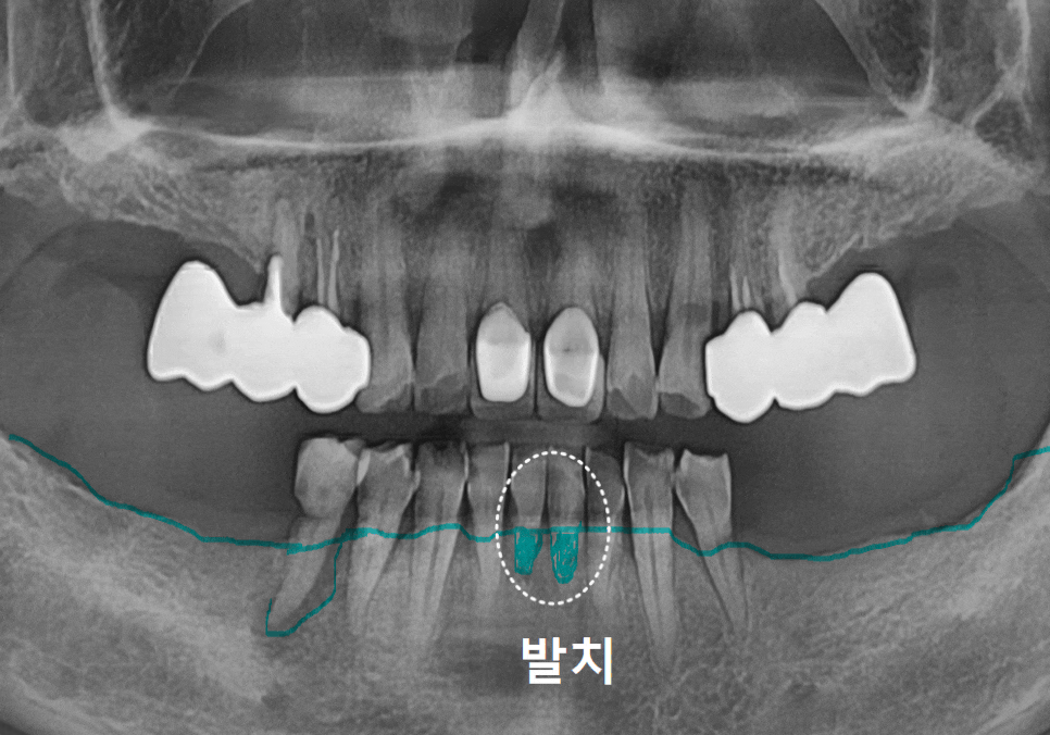강동구 임플란트 가격 줄이는 방법 2개 발치했는데, 1개만 심어도 된다구요? 관련 이미지 4