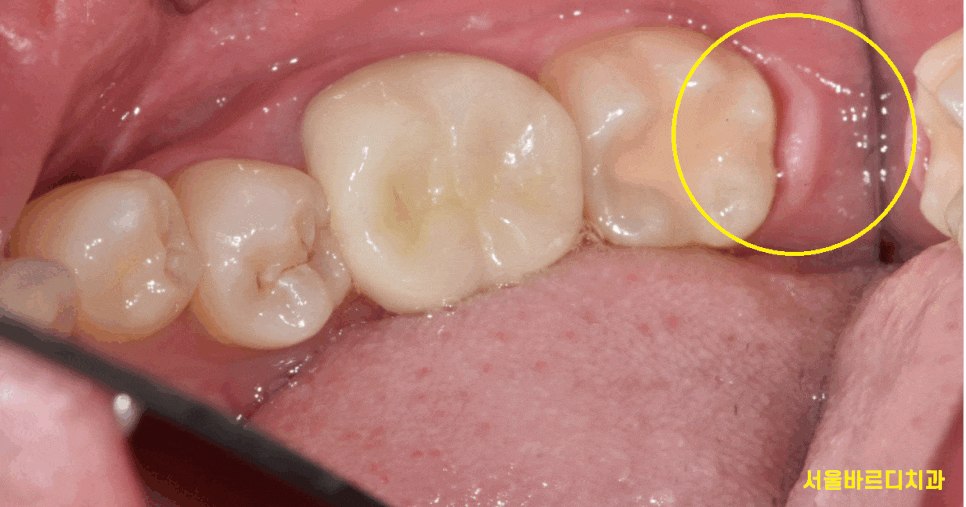 미사 사랑니 뽑아야하나 말아야하나 딱! 정리해드릴께요 관련 이미지 1
