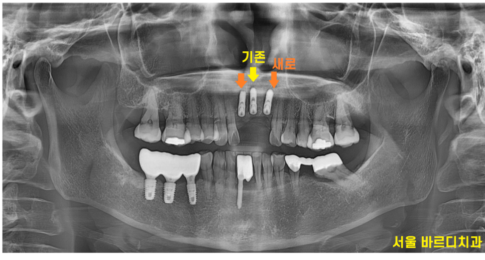 상일동역 치과 윗니 앞니 흔들림 임플란트로 심미까지 잡았습니다. 관련 이미지 8