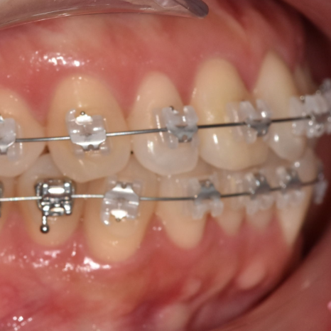 Can Protruding Mouth Be Corrected with Orthodontics Alone, Without Surgery? Sangil-dong Orthodontic Clinic image 3