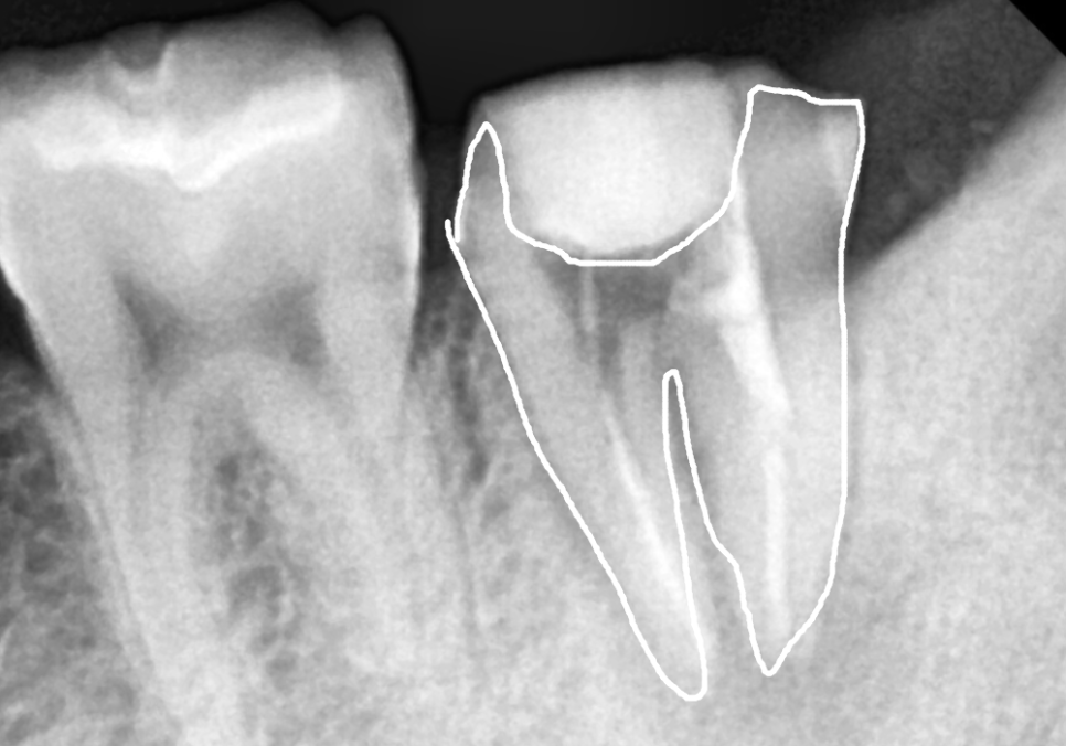 어금니 염증, 자연치 살리기에 진심인 저는 이렇게 살렸습니다. 관련 이미지 8