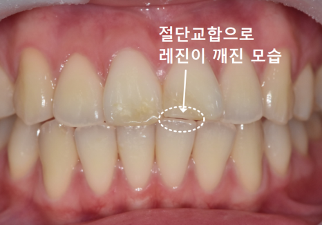 앞니 세로 줄, 똑같은 금이라도 진단 결과가 180도 다른 이유 관련 이미지 4