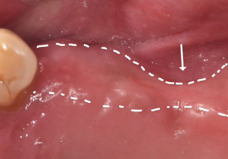 위 턱 전체 임플란트 vs 부분 틀니, 나에게 꼭 필요한 치료법 찾기 관련 이미지 10