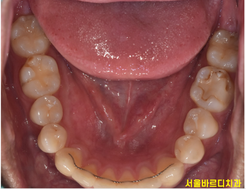 고덕동 치아교정 유지장치는 부정교합 재발을 막기위한 필수입니다! 관련 이미지 4