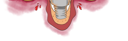 임플란트 수술 부작용 어떻게 예방할 수 있을까요? 관련 이미지 5