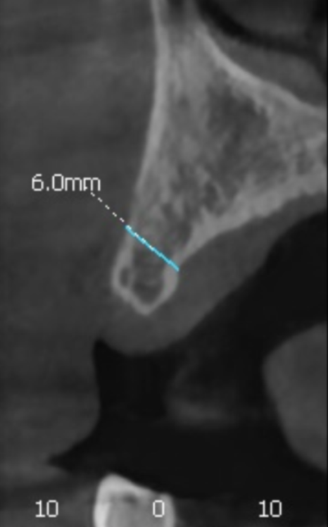 앞니 브릿지 부러짐, 이런 상태라면 절대 브릿지 다시 하지 마세요. 관련 이미지 10
