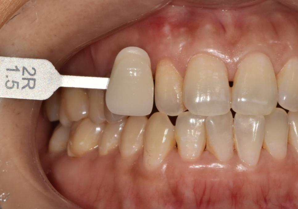 흔들리는 성인 잔존 유치, 50년 만에 송곳니 임플란트 하게 된 사연 관련 이미지 9