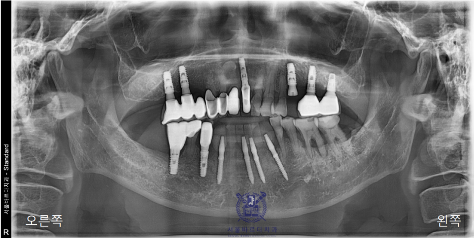 고덕동치과 서울바르디치과 전치부 및 구치부 임플란트 치료증례 #10 관련 이미지 13