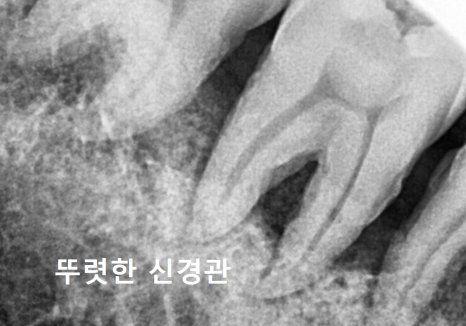 치아 시림 증상 때문에 고민이신가요? 그렇다면 양치질 너무 열심히 하지 마세요. 관련 이미지 10