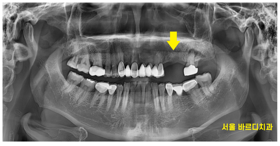 풍산동 임플란트 이 뽑고 임시틀니는 꼭 해야하나요? 플리퍼란? 관련 이미지 3