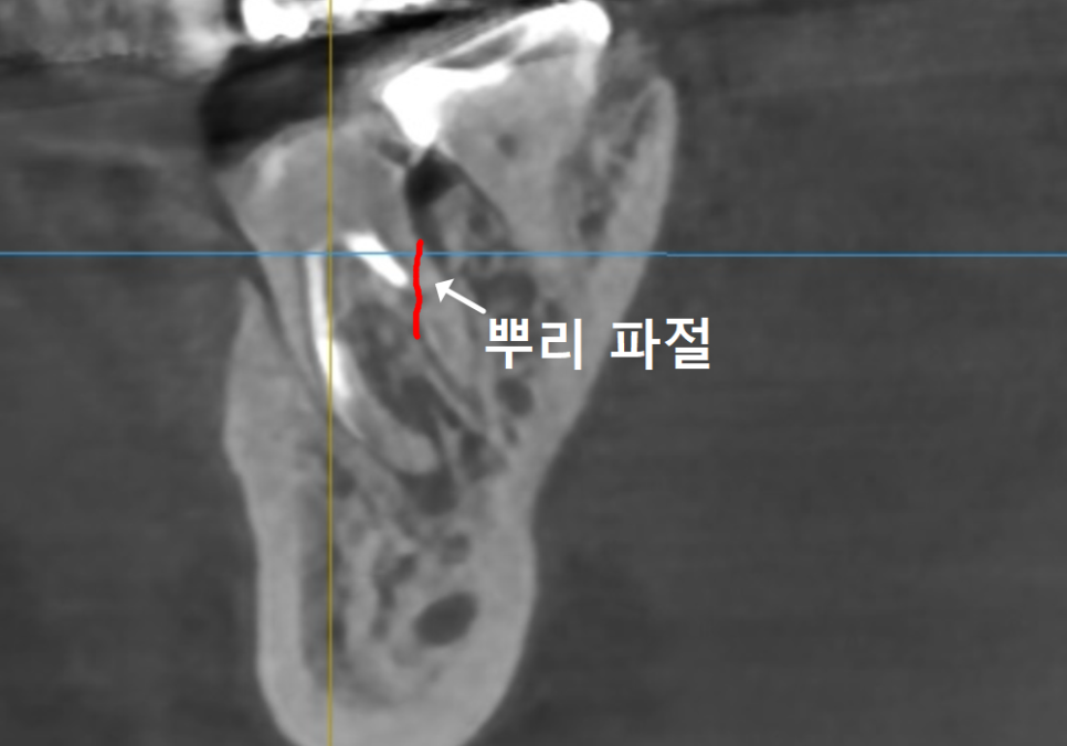 Honestly, Can an Unbroken Temporary Tooth Be Used Without a Crown? image 11