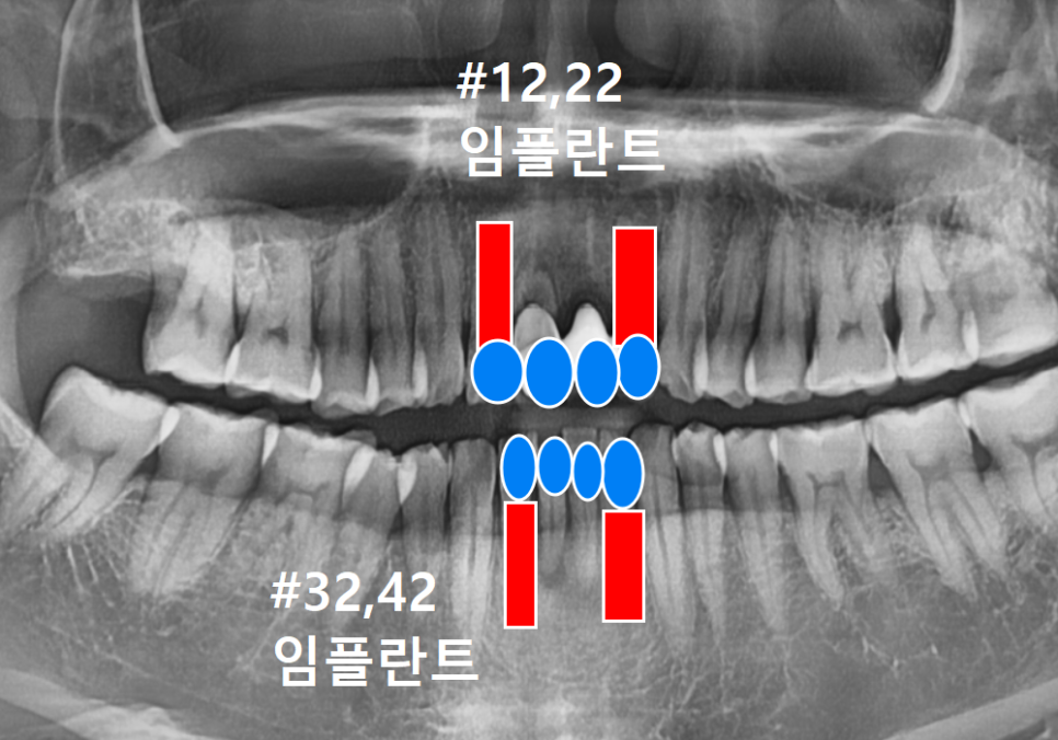 강일역 치과, 위 아래 앞니 임플란트 기간, 얼마나 걸리나요? 관련 이미지 13