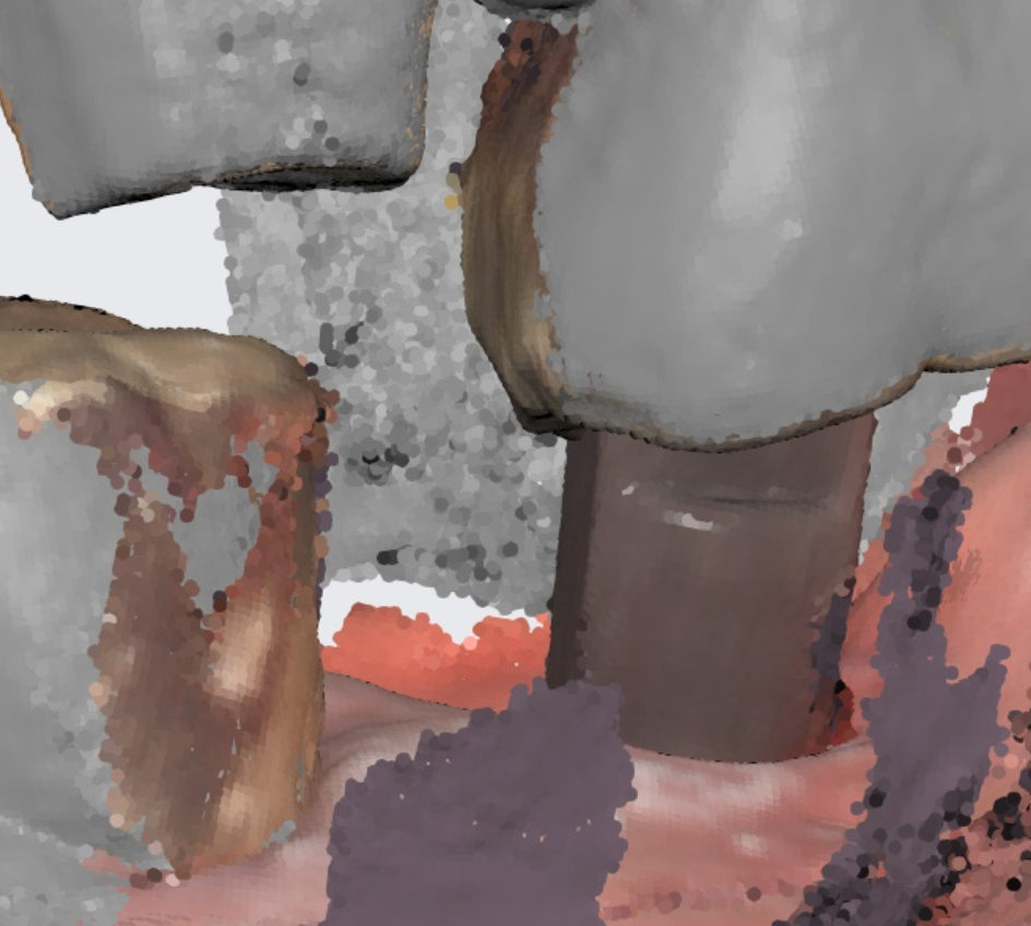 천호동 임플란트 치아 뿌리 충치가 파절을 유발하다. 관련 이미지 9