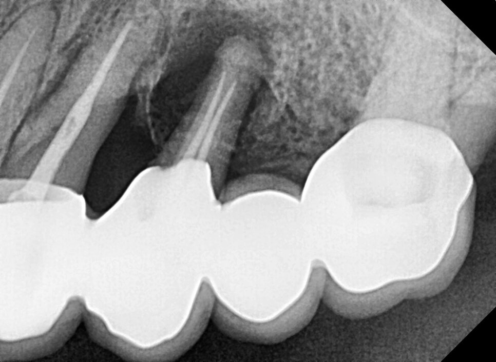 A Pimple Outside the Gums: Bridge Retreatment Implant Case Due to Bone Loss image 2