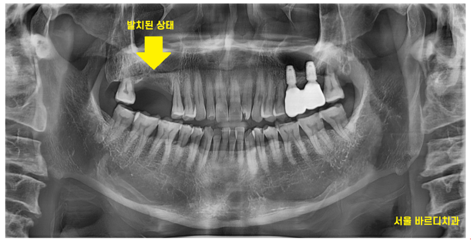 강일동 치과 전남 완도에서 올라오셔서 발치 후 당일 임플란트 완료하였습니다. 관련 이미지 2