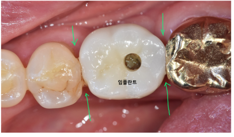 임플란트 충치 걱정? 잇몸을 먼저 생각하세요 관련 이미지 7