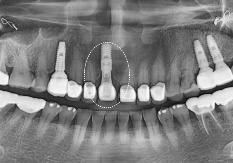 고덕동 앞니 보철, 브릿지와 싱글 크라운, 어떤 선택이 나에게 더 유리할까? 관련 이미지 19