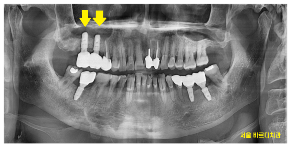 감일동 치과 어금니 시림 충치가 아닐 수도 있다? 임플란트 하게된 사연 관련 이미지 8