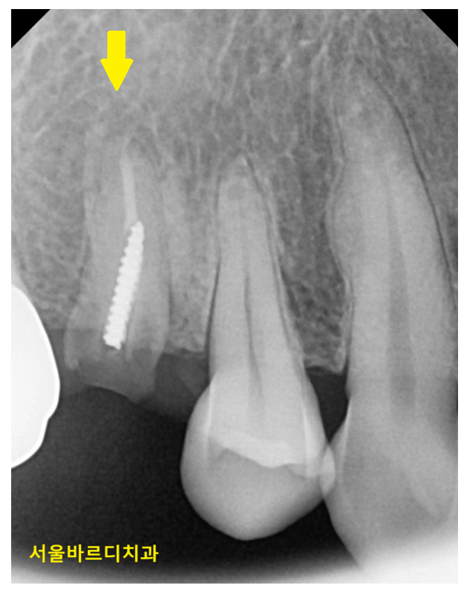씌운 치아 부러짐 뿌리만 남은 경우 임플란트로 수복하기 관련 이미지 5