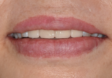 50대 라미네이트, 앞니 벌어짐과 변색 고민 이렇게 해결했습니다. 관련 이미지 11