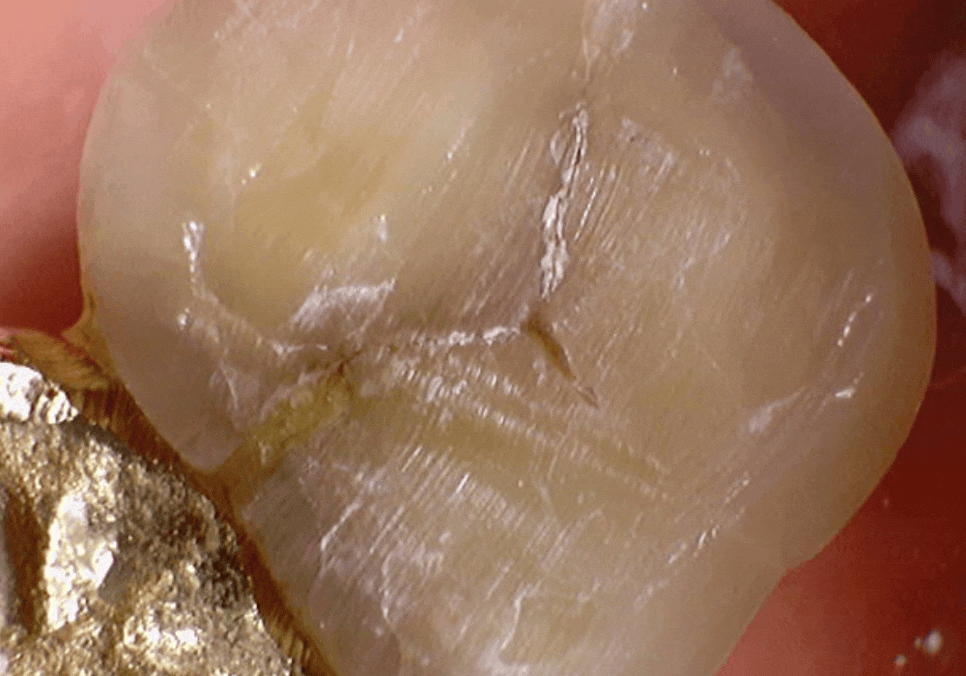 시큰거리는 통증, 시린 이 치약으로 해결 안 된다고요? 관련 이미지 6