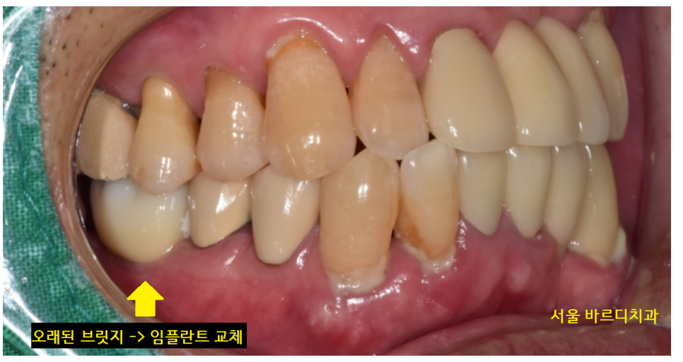 오래된 브릿지 보철 제거 후 고덕역 임플란트 교체 케이스 관련 이미지 10