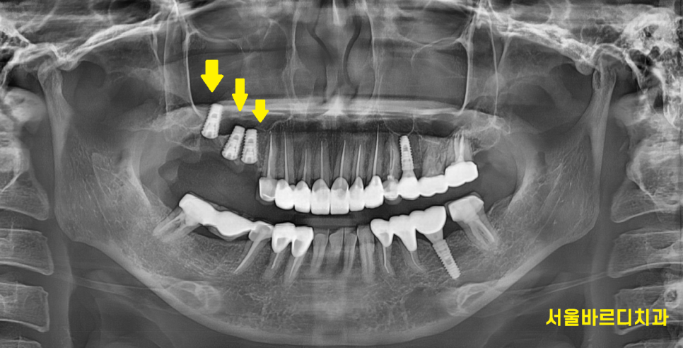 보철 부러짐 발생으로 치아 뿌리만 남았을 때 치료 방법 임플란트 관련 이미지 6