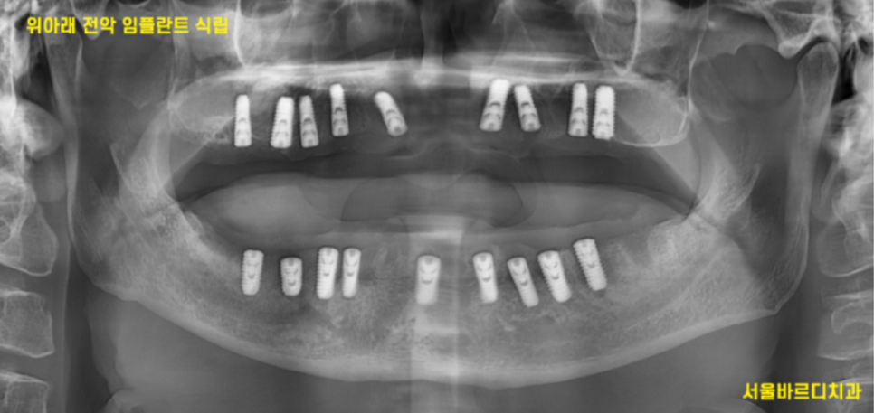 임플란트 2차 수술 과정 아직도 안끝났어요? 죄송합니다!! 관련 이미지 4