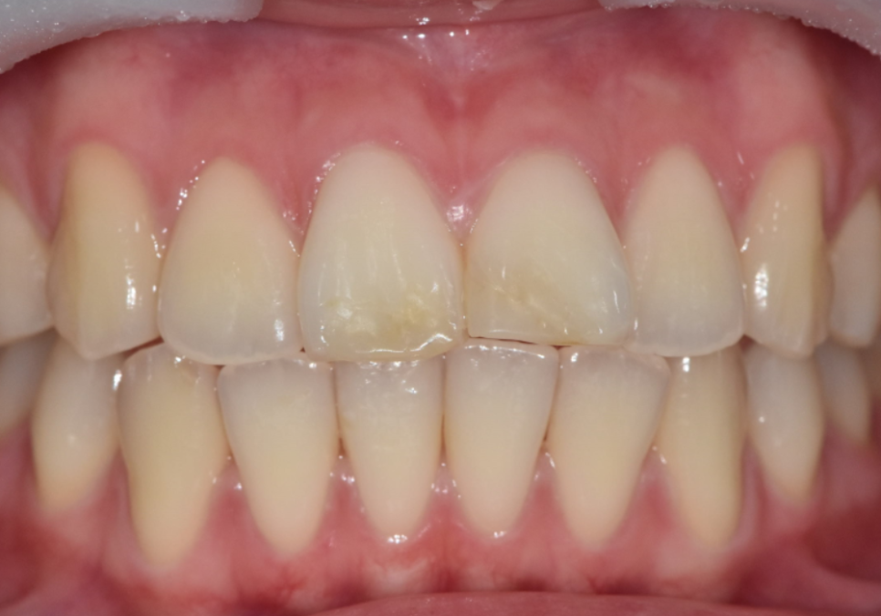 절단교합으로 인한 앞니 레진 깨짐, 교정 없이 해결한 사례 관련 이미지 2