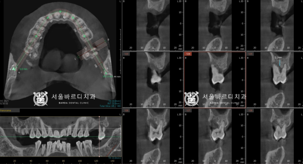고덕동치과 서울바르디치과 무절개 네비게이션 임플란트 치료증례 #1 관련 이미지 8