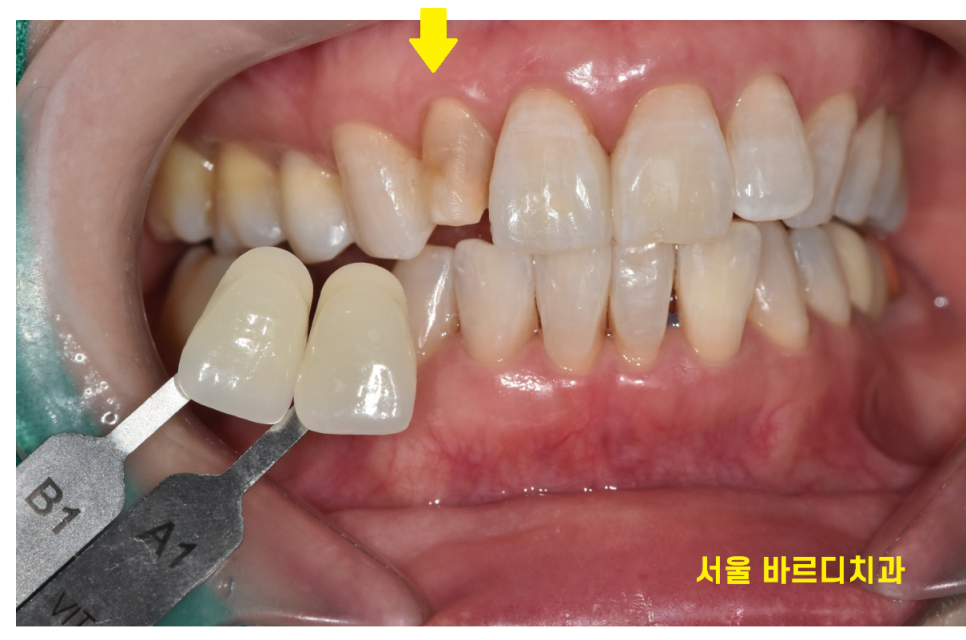 상일동역 라미네이트 치아 무삭제 정말 가능한가요? 관련 이미지 6