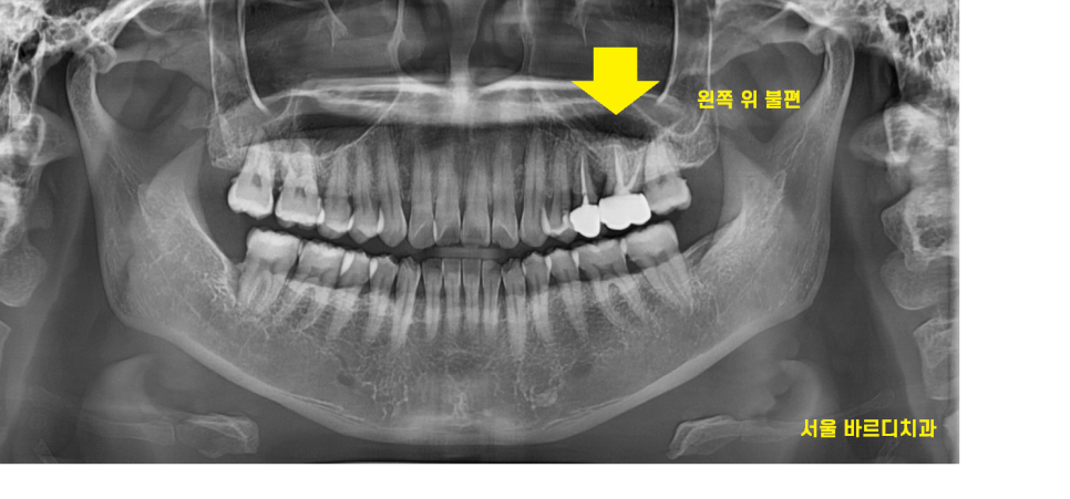 덕풍동 치과 씹을때 통증 임플란트로 극복했습니다. 관련 이미지 2