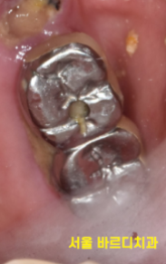 천호동 치과 임플란트 크라운 종류 설명 나갑니다. 관련 이미지 8